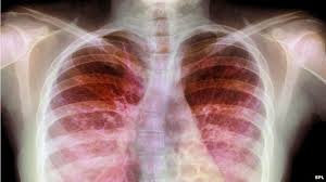 Image result for cystic fibrosis