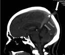 Cutaneous lesions in occult spinal dysraphismcorrelation with