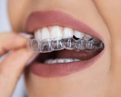 Image of Clear Aligners