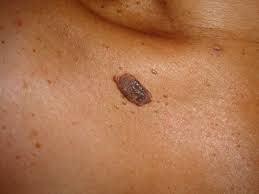 Resultado de imagem para nevos