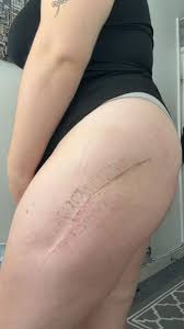 Is this posterior or anterior my surgeon never said ?