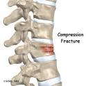 Compression fracture of the spine