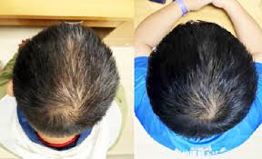 Can a plant-based hair growth serum really regrow hair in weeks?