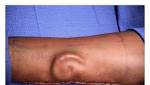  A soldier needed an ear transplant. Doctors 'grew' a new one in her arm.
