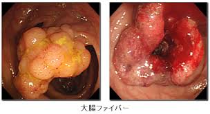 「大腸癌」の画像検索結果