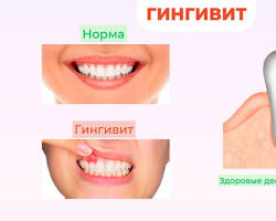 Image of Гингивит