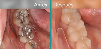 Resultado de imagen para resinas compuestas