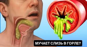 Почему скапливается слизь в горле: 10 главных причин, о ...