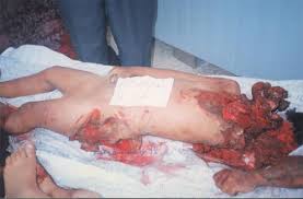 Image result for depleted+uranium+babies