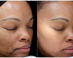 Image of hyperpigmentation before and after chemical peel