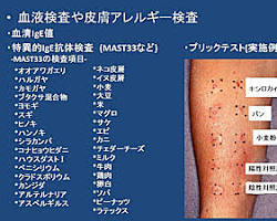 アレルギー性皮膚炎の画像