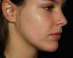 acne ile ilgili görsel sonucu