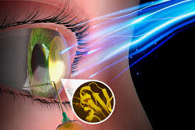 Revolutionary Biomaterial to Restore Sight: A Breakthrough in Light-Activated Cornea-Thickening - 1