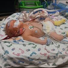 Violet's CDH Story — Tiny Hero: Real Hope for CDH