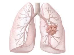 Image result for Lung Cancer