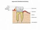 Heilmittel gegen zahnfleischentzundung
