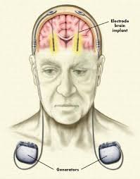Deep Brain Stimulation for the Soul - bb_July2004_large