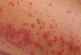 Hasil gambar untuk Rash