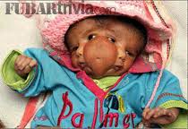 Lalli Singh: The girl with two faces. Lali Singh: The girl with two faces. Baby girl Lali Singh was born in March 2008 in India with a medical condition ... - lalli_singh