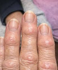 What causes hard bumps on finger joints near nails?