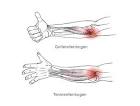 Schmerzen Daumen bis zum Ellbogen - t
