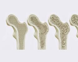 Imagem de Osteoporose