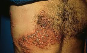 Hasil gambar untuk penyakit aids hiv