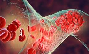 The Growing Rate of Venous Thromboembolism Following Cancer Surgery - 1