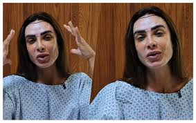 Nicole Bahls passa por transplante capilar após alopecia: 'Ficar mais cabeluda'