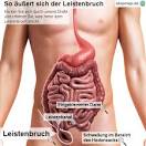 Leistenbruch ist Männersache Höchster Kreisblatt