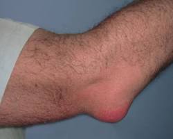 Imagen de Bursitis de codo
