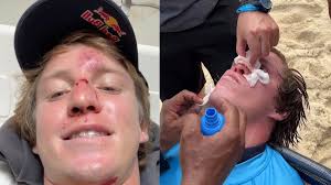 Do hospital ao pódio: Lucas Fink sofre acidente antes da final, compete com nariz fraturado e é vice no Gigantes de Nazaré