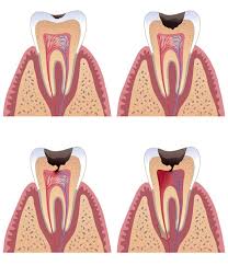  ثقوب الأسنان تحمي من بعض أنواع السرطان Images?q=tbn:ANd9GcT7LRg8yDGBT1BjSJ7KlKUHAC8osr6cWS4hhQX1uQHSbuBtnUsWrg