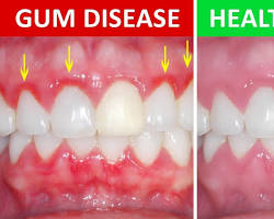 Image of Healthy Gums vs. Gums with Gingivitis