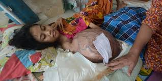 Image result for kanker