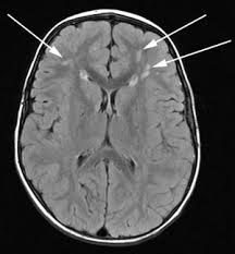 Image result for stroke mri