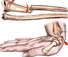 «اليزاروف» .. تعالج الكسور المعقدة وتؤمن عمليات إطالة العظام وإصلاح تشوهاتها. Images?q=tbn:ANd9GcT8q0y48bWdPvOKfUmdT4Ucic2w-Yu1OS6I3GW3VVQto-rYtINL