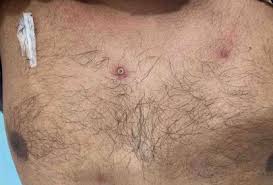Mpox: é preciso usar máscaras? Como prevenir? Quais os sintomas? Tire dúvidas
