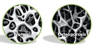 Resultado de imaxes para osteoporosis