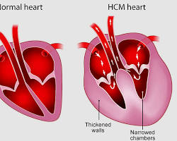 cat with hypertrophic cardiomyopathyの画像