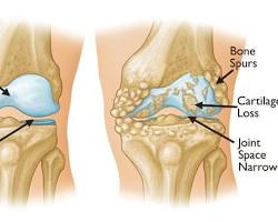 person with knee osteoarthritis