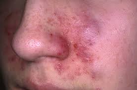 natural remedies eczema face