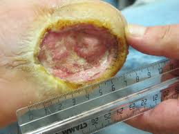 диабетическая стопа