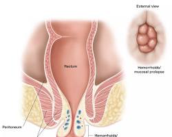 Image of External hemorrhoids
