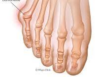 Image of Bunions foot