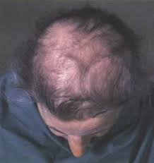 Image result for radiation sickness