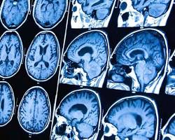 Imagem de Causas da Cefaleia por tumor cerebral