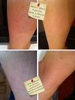 Epilation definitive lumiere pulsee avis