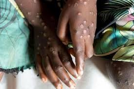 Monkey pox is not the new covid-19, experts say