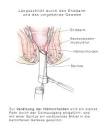 Soforthilfe bei hamorrhoiden schmerzen